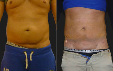 Before and after abdominal liposuction showing reduced fat and improved definition