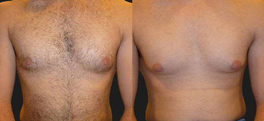 Before and after male chest alexandrite laser hair removal showing reduced hair density on the upper torso