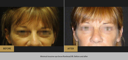 Before and after eyebrow lift showing elevated brows and smoother forehead contour