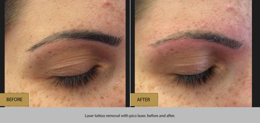 Before and after laser tattoo removal with pico laser