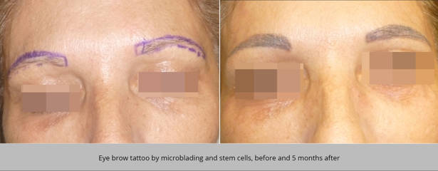 Before and 5 months after eyebrow tattoo by microblading and stem cells