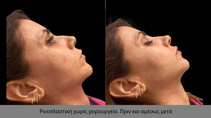 Rhinoplasty82