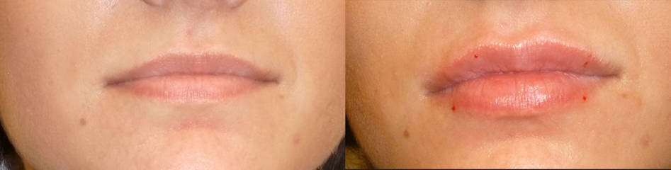 Before and after lip filler treatment showing fuller, better defined lips with natural contour