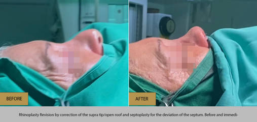 Close up of rhinoplasty revision patient under surgery lights, showing correction of supra tip and septum