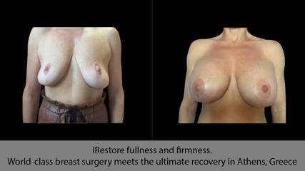 IRestore fullness and firmness. World-class breast surgery meets the ultimate recovery in Athens, Greece