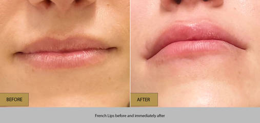Before and after French Lips treatment