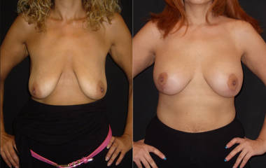 Before and after breast lift showing improved firmness and nipple position
