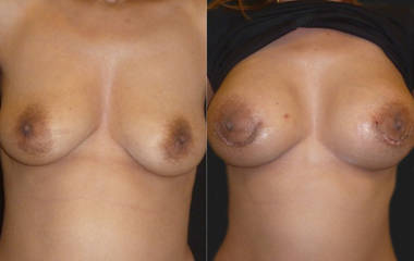 Before and after breast augmentation with silicone implants showing natural symmetry and enhancement