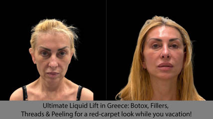 Ultimate Liquid Lift in Greece: Botox, Fillers, Threads & Peeling for a red-carpet look while you vacation!