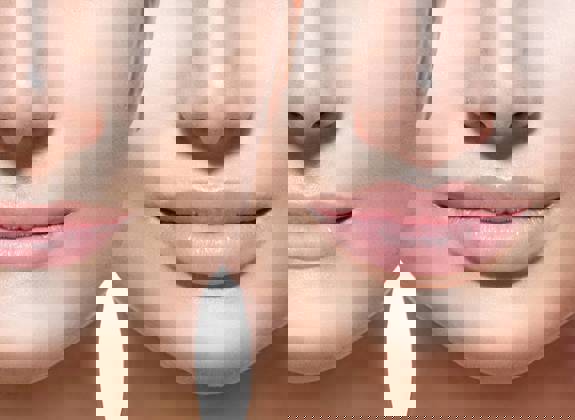 Illustrated portrait of a woman's face demonstrating the before and after lip fillers procedure