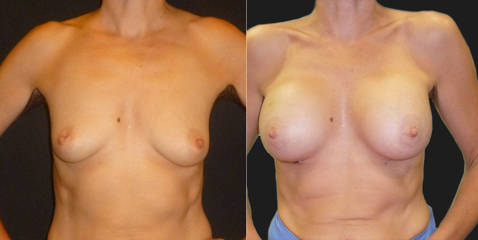 Before and after breast augmentation showing enhanced volume and refined symmetry with silicone implants