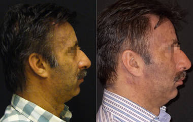Before and after comparison showing a man's profile with improved skin tone and reduced pigmentation