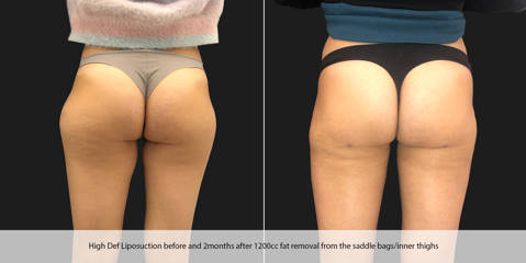 Before and two months after high-definition liposuction showing refined thighs and smoother lower body