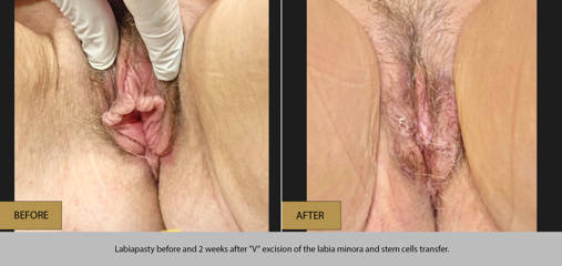 Labiaplasty before and 2 weeks after V excision of the labia minora and stem cells transfer