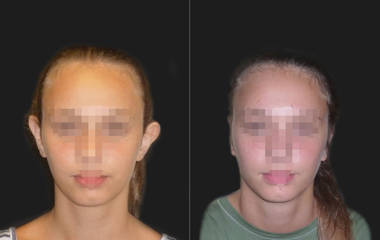 Before and after otoplasty showing corrected ear projection and natural ear symmetry