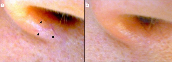 Before and after laser removal of spider veins at the side of the nose, showing clearer skin