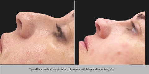 Close up before and after non-surgical rhinoplasty using 1cc hyaluronic acid to smooth the nasal tip and hump