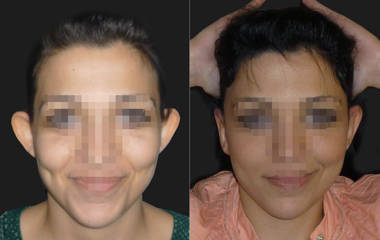Before and after otoplasty showing correction of highly protruding ears and restored natural ear position