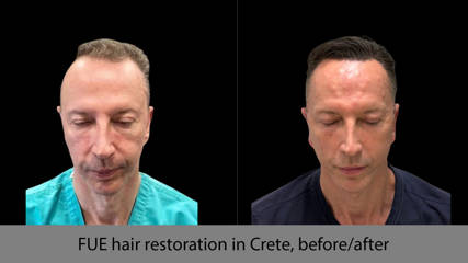 Αποκατάσταση μαλλιών FUE στην Κρήτη, πριν/μετά