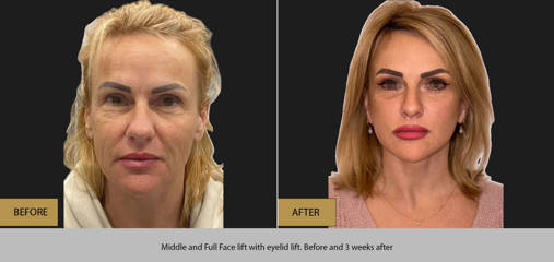Before and 3 weeks after middle and full face lift with eyelid lift