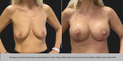 Before and after breast lift and augmentation with 425cc high profile round silicone implants