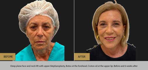 Before and 6 weeks after plane face and neck lift with upper blepharoplasty, forehead Botox and Croton oil treatment