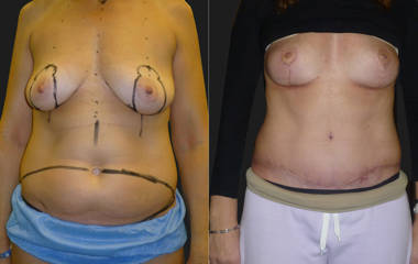 Before and after Mommy Makeover showing combined breast lift and abdominoplasty for post-pregnancy restoration