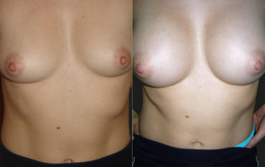 Before and after breast augmentation showing enhanced breast volume and improved symmetry