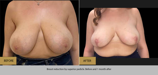 Before and after breast reduction showing lighter and lifted breasts one month after surgery
