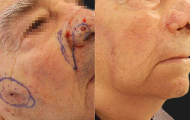 Before and after photos showing surgical excision and reconstruction of a facial skin lesion on the cheek