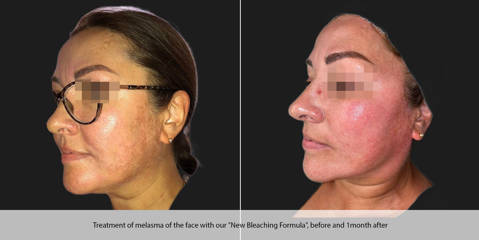 Before and one month after treatment of melasma of the face with our new bleaching formula