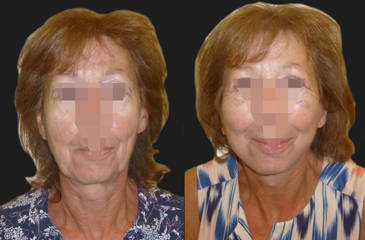 Before and after full facelift showing refined jawline, tighter neck and natural-looking facial rejuvenation 