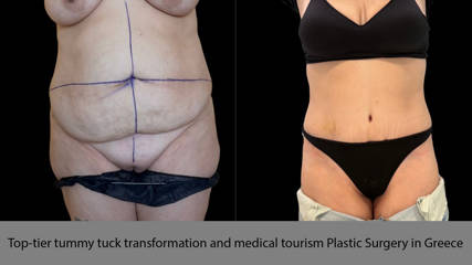 Top-tier tummy tuck transformation and medical tourism Plastic Surgery in Greece