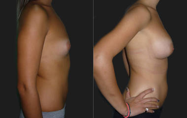 Side view breast augmentation with silicone implants showing improved fullness and natural projection