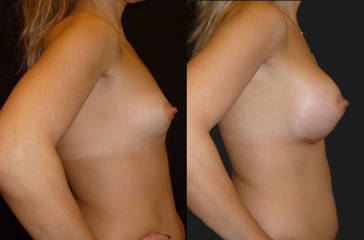 Before and after breast augmentation showing enhanced volume and improved breast contour