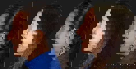 Woman in profile before and after rhinoplasty, showing refined nasal contour and natural post-op result