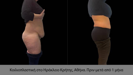 Abdominoplasty26