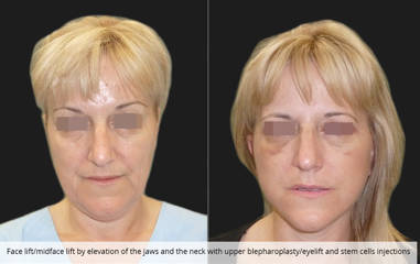 Woman before and after face and midface lift with jaw and neck elevation, upper eyelid surgery and stem cell injections