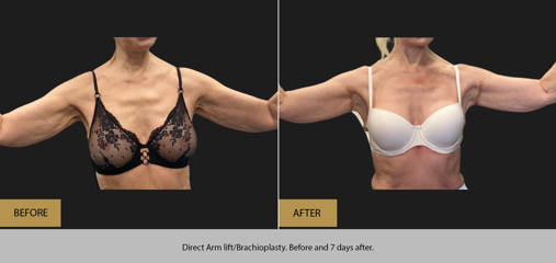 Direct Arm lift/ Brachioplasty. Before and 7 days after