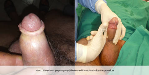Before and after micro-circumcision procedure performed for phimosis treatment