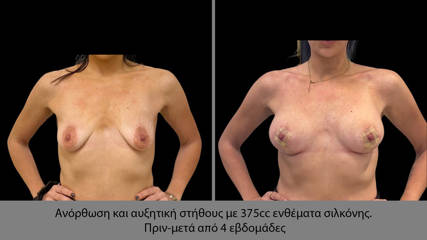 Breast Lift (1)