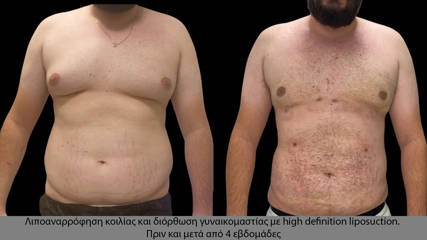 Liposuction (1)