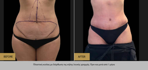 Abdominoplasty with correction of white line hernia, before and one month after surgery