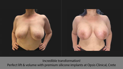 Incredible transformation! Perfect lift & volume with premium silicone implants at Opsis Clinical, Crete