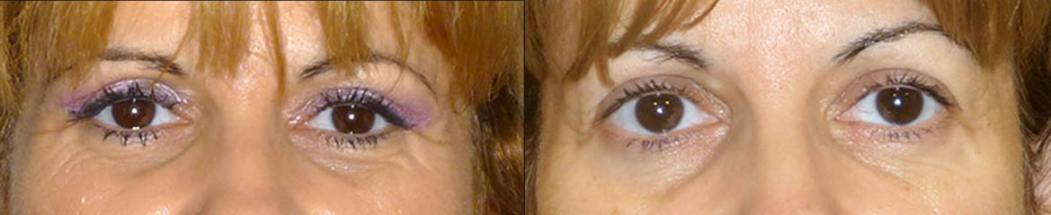 Before and after upper and lower blepharoplasty showing rejuvenated eye contour and reduced wrinkles