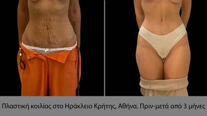 Abdominoplasty 25