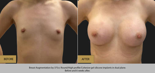 Breast augmentation by 375cc silicone implants in dual plane, before and 6 weeks after