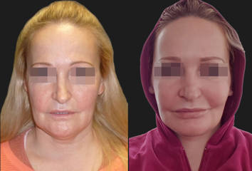 Before and after cheek implant surgery showing improved mid-face fullness and smoother contour