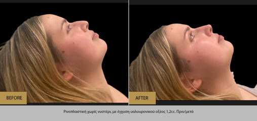 Before and after non-surgical rhinoplasty using 1.2cc hyaluronic acid injection to smooth nasal contour