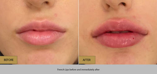 French Lips treatment before and immediately after  